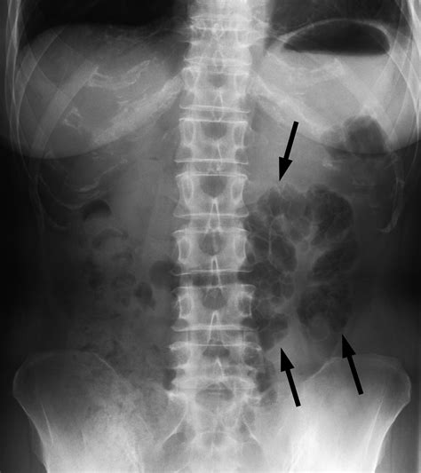 Pneumatosis Cystoides Intestinalis