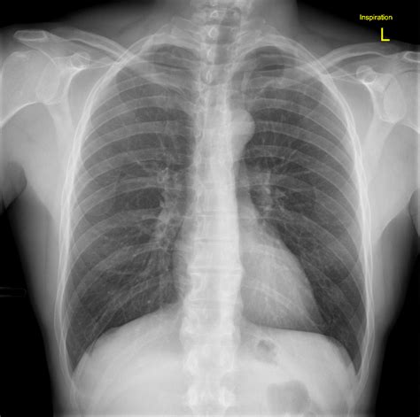 What Does A Displaced Rib Look Like at Gabriella Raiwala blog