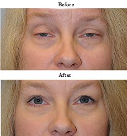 Oculoplastic Surgery In Tanda | Oculoplastic Surgery In Begowal ...