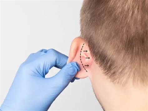 Evidence Of First-Ever Ear Surgery From 5,300 Years Ago Found In Spain