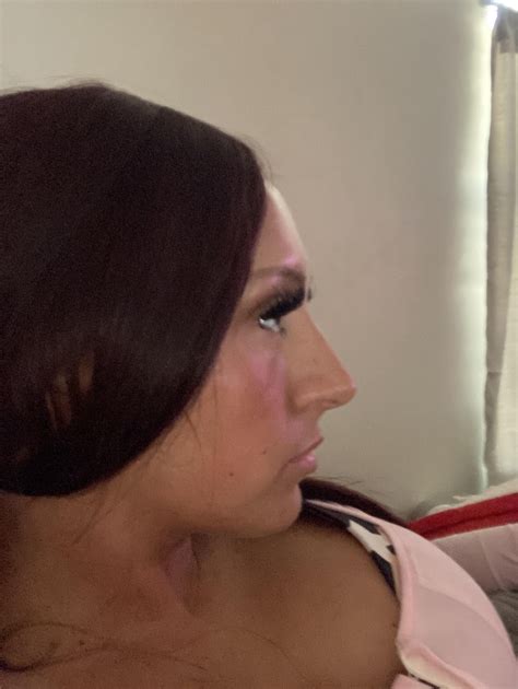 Am I a good candidate for a liquid nose job or rhinoplasty? : r ...