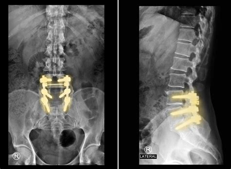 Anterior Lumbar Interbody Fusion (ALIF)