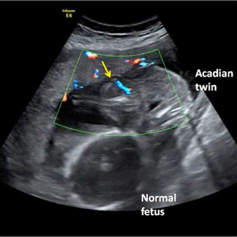 Management of a Delayed Diagnosed Acardiac Twin Pregnancy with TRAP ...