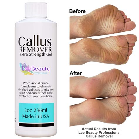 Callus In Feet Treatment at Patrick Lauzon blog