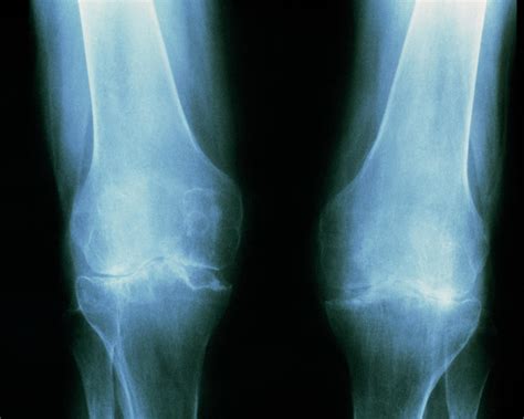 Tinted X-ray Of Rheumatoid Arthritis In The Knees. Photograph by ...
