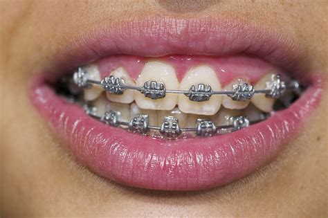Inspirasi Terpopuler Teeth With Braces, Trend Terbaru!