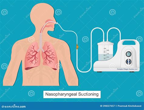 Nasogastric Intubation Medical Science Vector Illustration | CartoonDealer.com #285693418