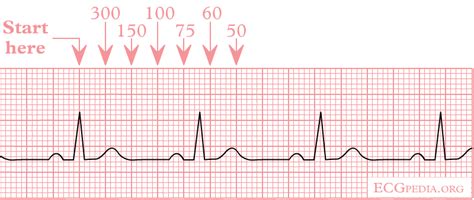 The Normal ECG