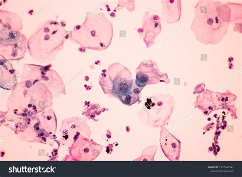 Abnormal Squamous Epithelial Cells View Microscopy Stock Photo ...