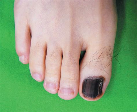 Hutchinson's sign nose and nail
