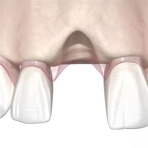 Socket Preservation | Arlington Oral Surgery