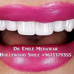 Direct Veneers | Composite Veneers Lebanon