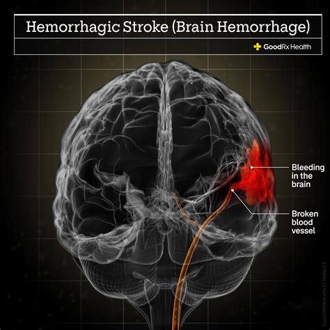 The Differences Between Bell's Palsy vs. Stroke - GoodRx