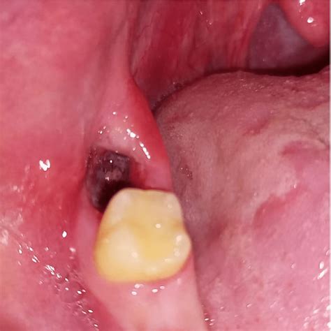 Tooth Socket After Extraction 的图像结果