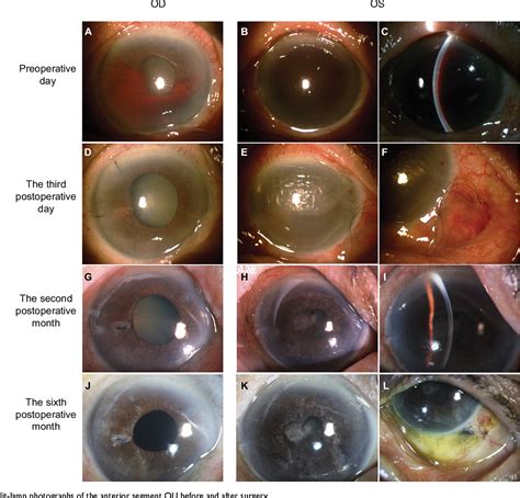 Figure 1 from Eight-ball hyphema after laser iridotomy in a patient ...