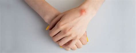 Lipoma Treatment