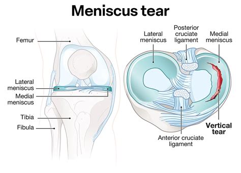 Lateral Meniscus Anatomy Meniscus Injuries & Management – Home