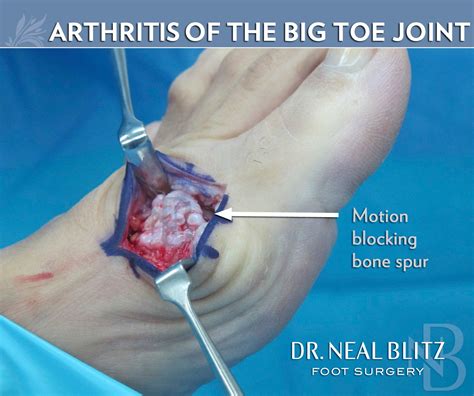 Big Toe Arthritis Surgery – Learn about Symptoms & Treatment