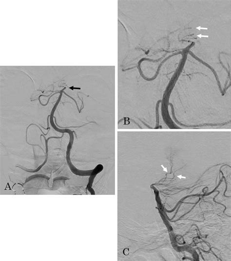Figure 2 from A case of posterior cerebral artery occlusion that developed into an artery of ...