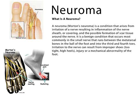 I have been diagnosed with a Neuroma… – Footcare Express