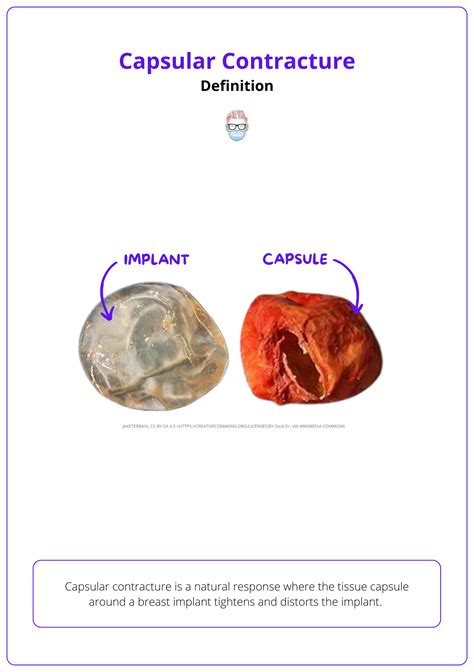 Capsular Contracture Causes | Capsular Contracture Treatment - SQMKS