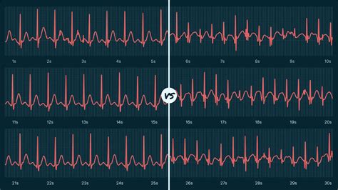 Sinus Tachycardia Vs. Supraventricular Tachycardia (Sustained) on Your ...