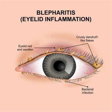 Blepharitis (Eyelid Inflammation) Stock Illustration - Illustration of ...