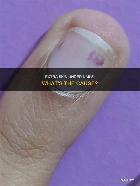 Skin Growing Underneath Nail