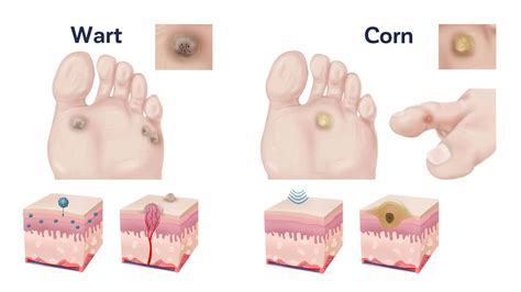 What Is The Difference Between A Corn And A Wart On The Foot