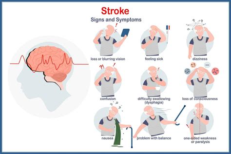 Medical vector illustration in the concept of stroke symptoms.blurring vision,dizziness,problems ...