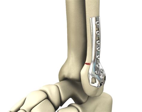 Ankle Fracture Repair Los Angeles | Broken Ankle Glendale | Pasadena