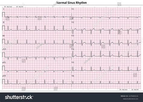 Normal Single Lead Ekg: Ecg Normal Définition – XQYWGJ