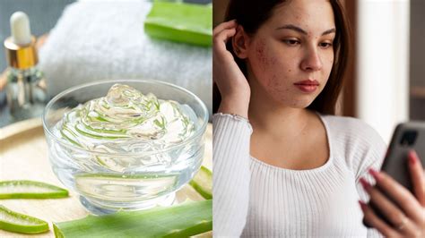 Aloe vera can reduce hyperpigmentation, says my mom