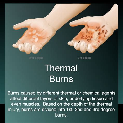 Acute Thermal Burns