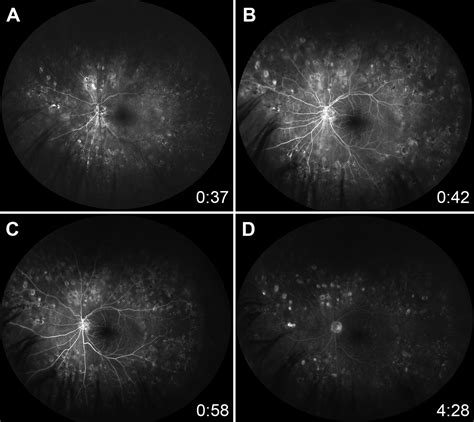 Ocular Ischemic Syndrome With Congenital Absence of Internal Carotid ...