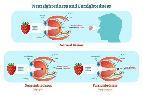 What Is Nearsighted And Farsighted? | Holly Springs Eye & Laser