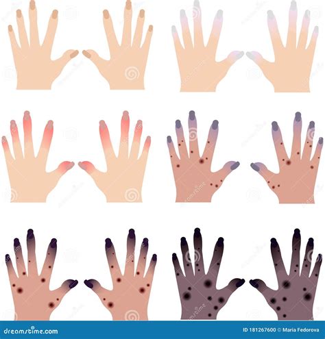 Sore Hands. Skin Diseases. Ulcers and Rashes. Gangrene and Necrosis ...