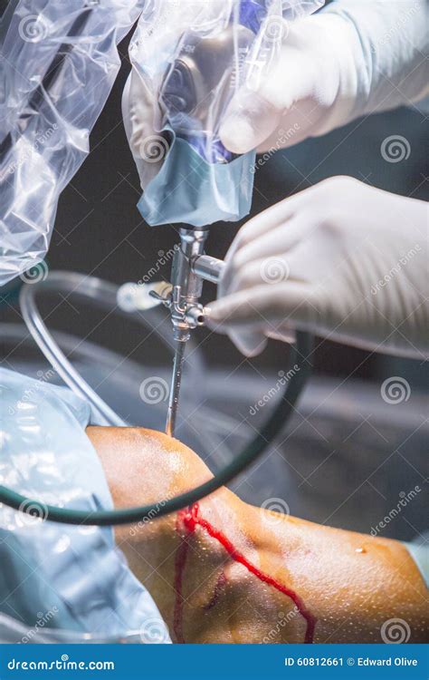Arthroscopy Orthopedic Surgery Knee Arthroscope Probe Stock Image - Image of emergency, fluid ...
