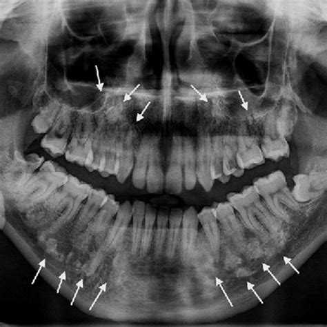 गार्डनर सिंड्रोम क्या है? कारण, लक्षण और इलाज | Gardner Syndrome in Hindi