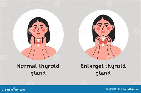 Normal and Enlarget Thyroid Gland. Woman Showing Thyroid Gland on Her ...