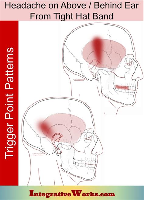 Headache Above/ Behind Ear Wearing Hat - Integrative Works | Headache, Tooth pain relief, Tooth pain