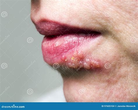 Herpes on lip stock photo. Image of shingles, illness - 97605104