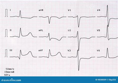 ECG with Acute Period of Large-focal Posterior Diaphragmatic Myocardial ...