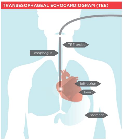 Transesophageal Echocardiogram (TEE) | Heart and Stroke Foundation