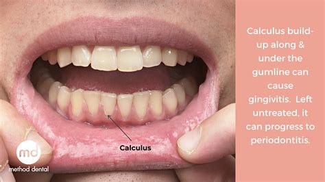 Image result for Tooth Calculus