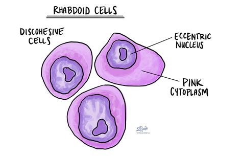 Rhabdoid | MyPathologyReport