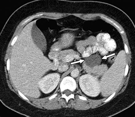 Cystic Lesions of the Pancreas | AJR