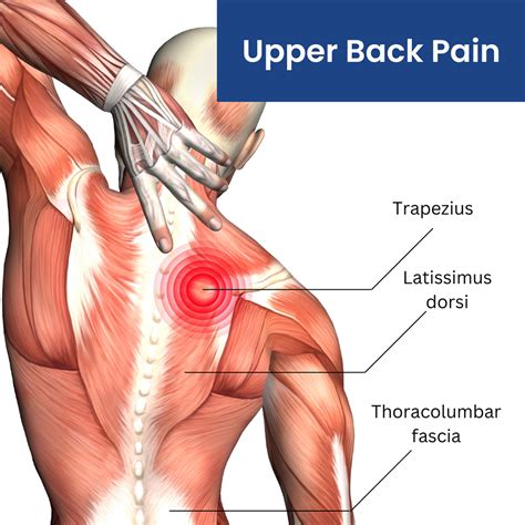 Upper Back Pain Causes And Treatment You - Infoupdate.org