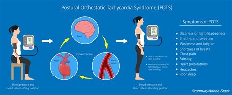 Pots Disease Blood Pressure at Neil Mooneyhan blog
