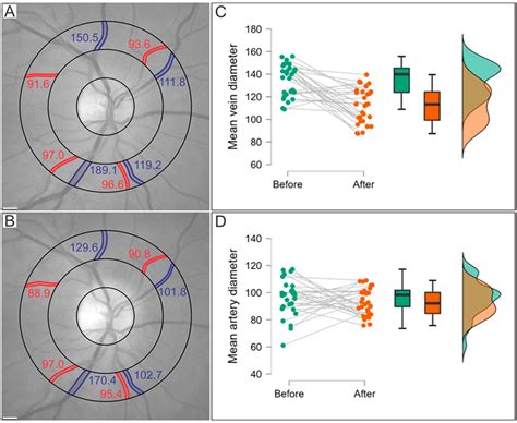 The Comparison of Retinal Microvascular Findings in Acute COVID-19 and ...